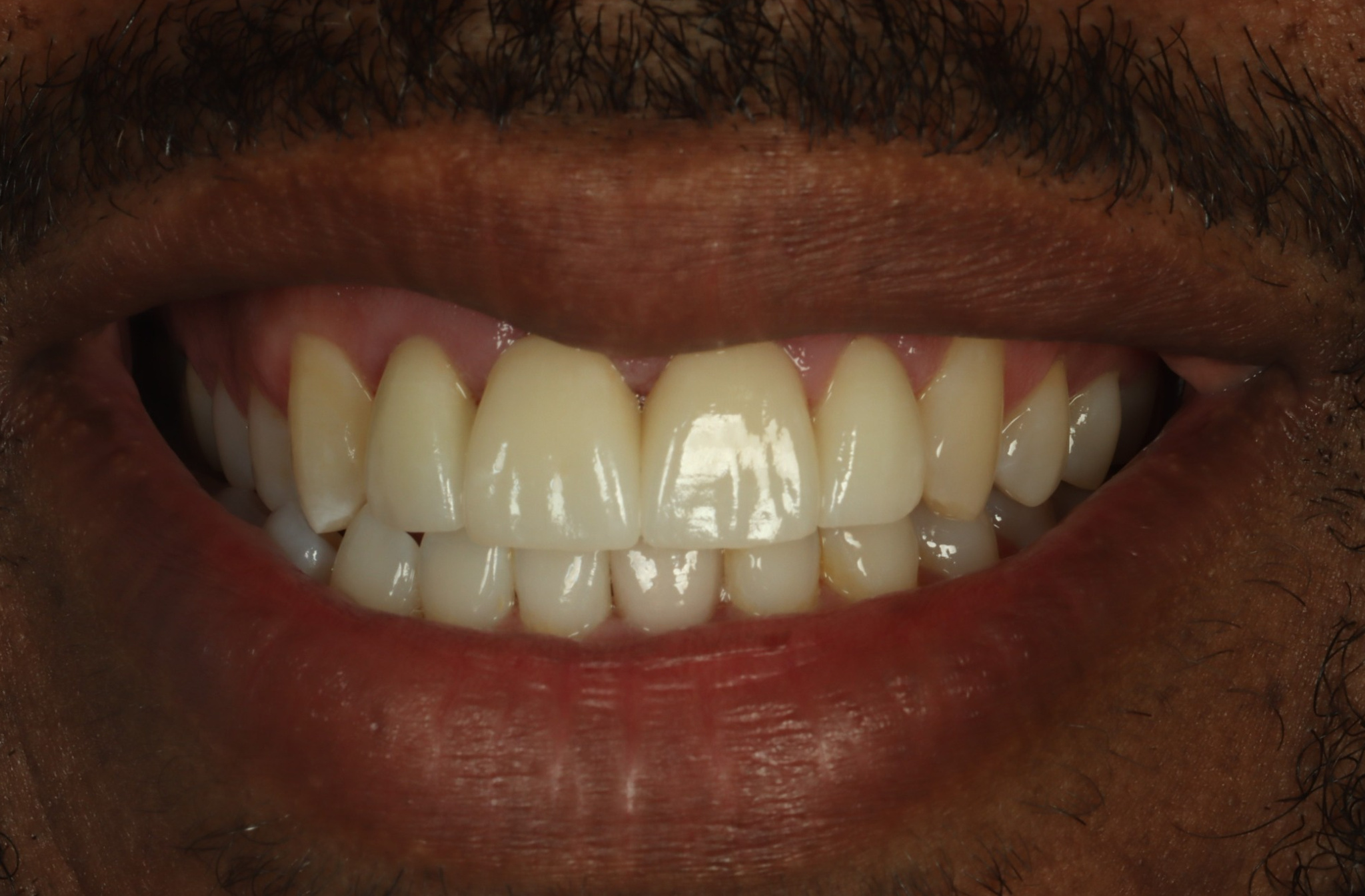 Anthony N after gummy smiles