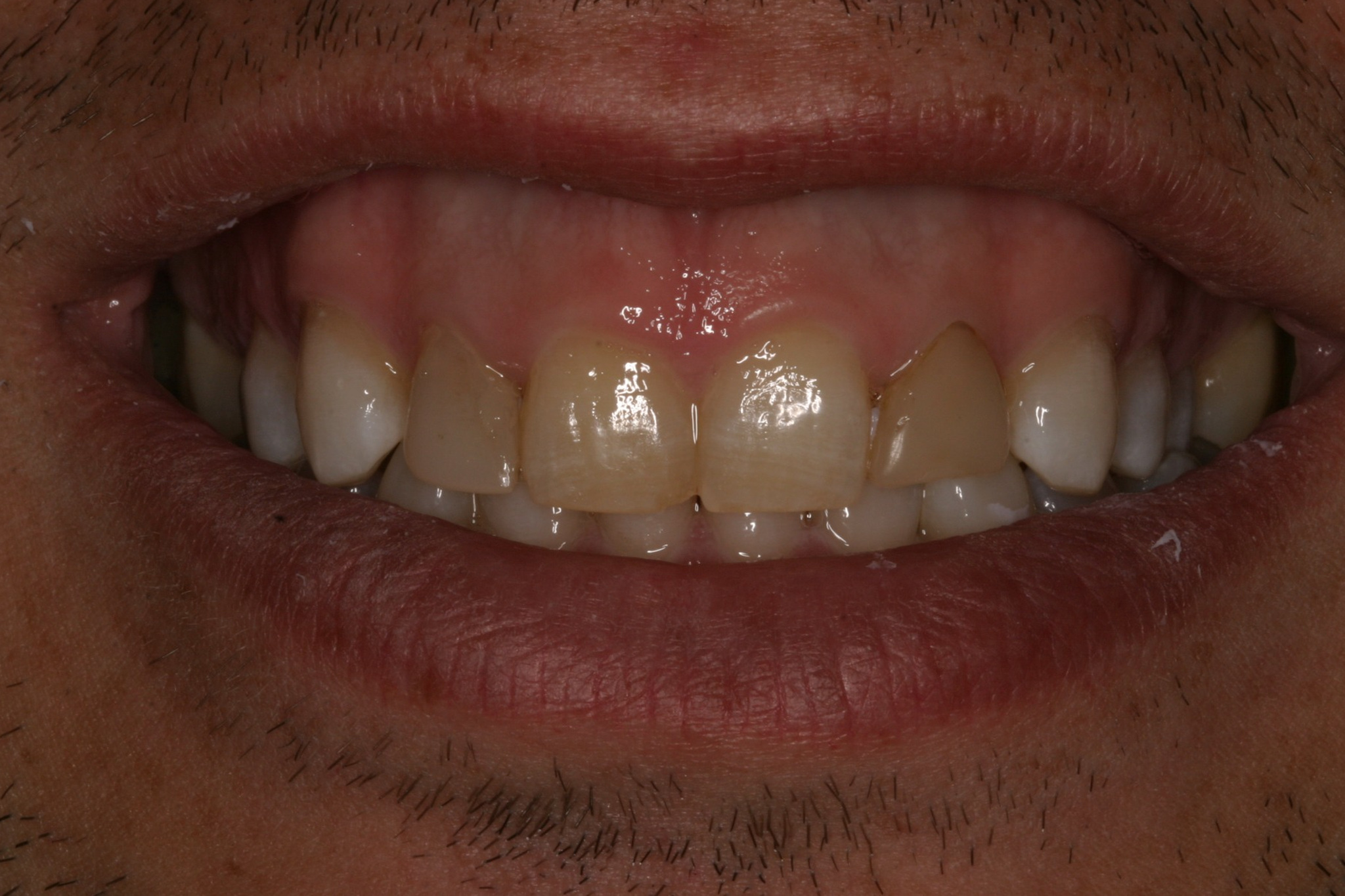 Christopher O before discolored teeth