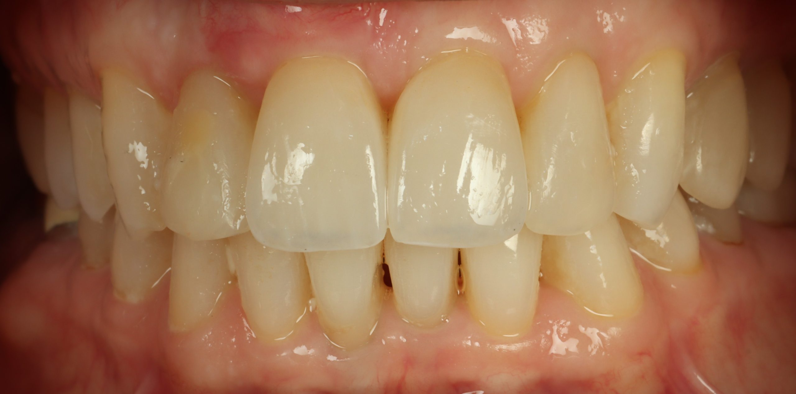 Diane L after dental veneers