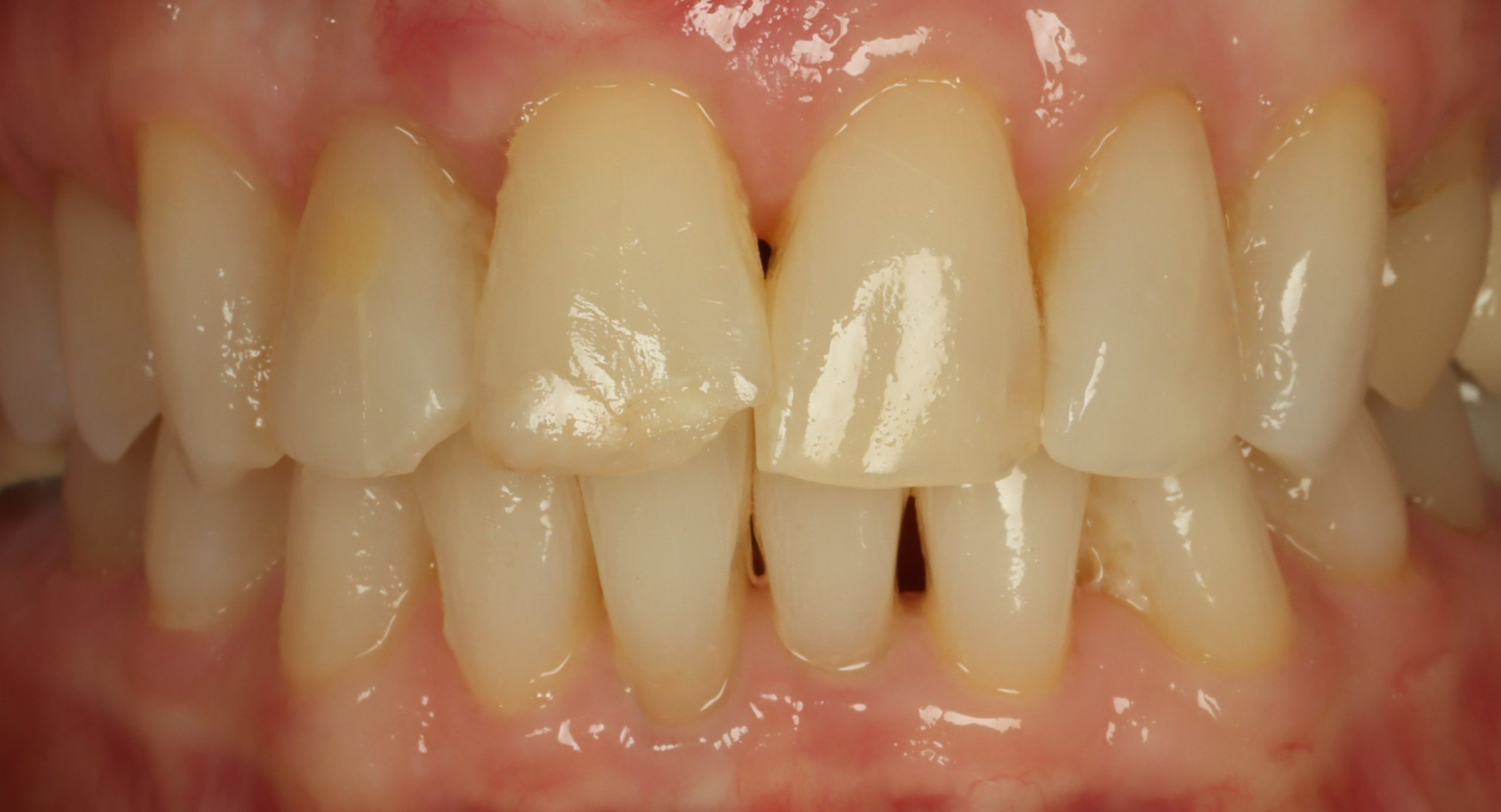 Diane L before dental veneers