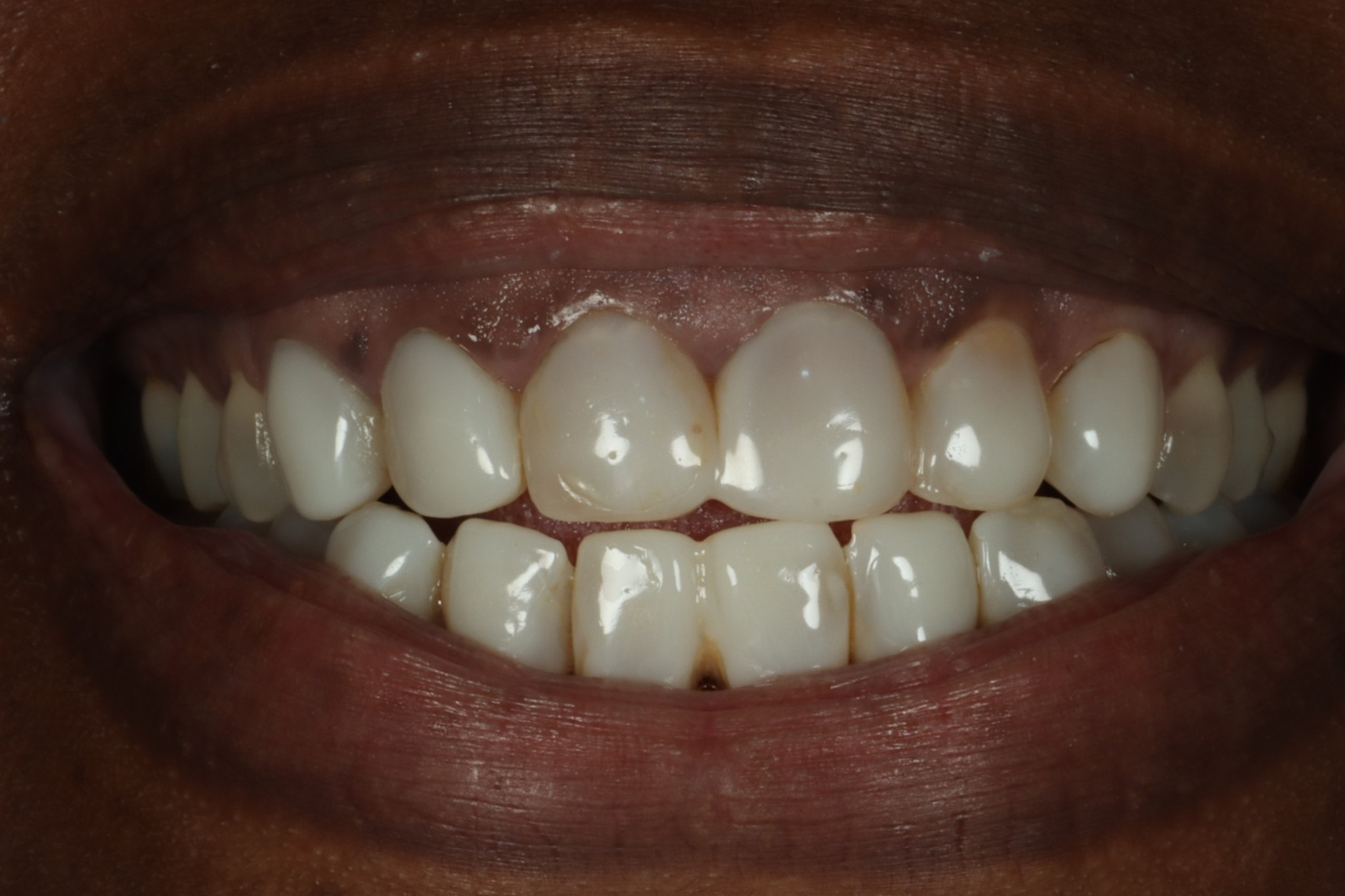 Nicole T before discolored teeth