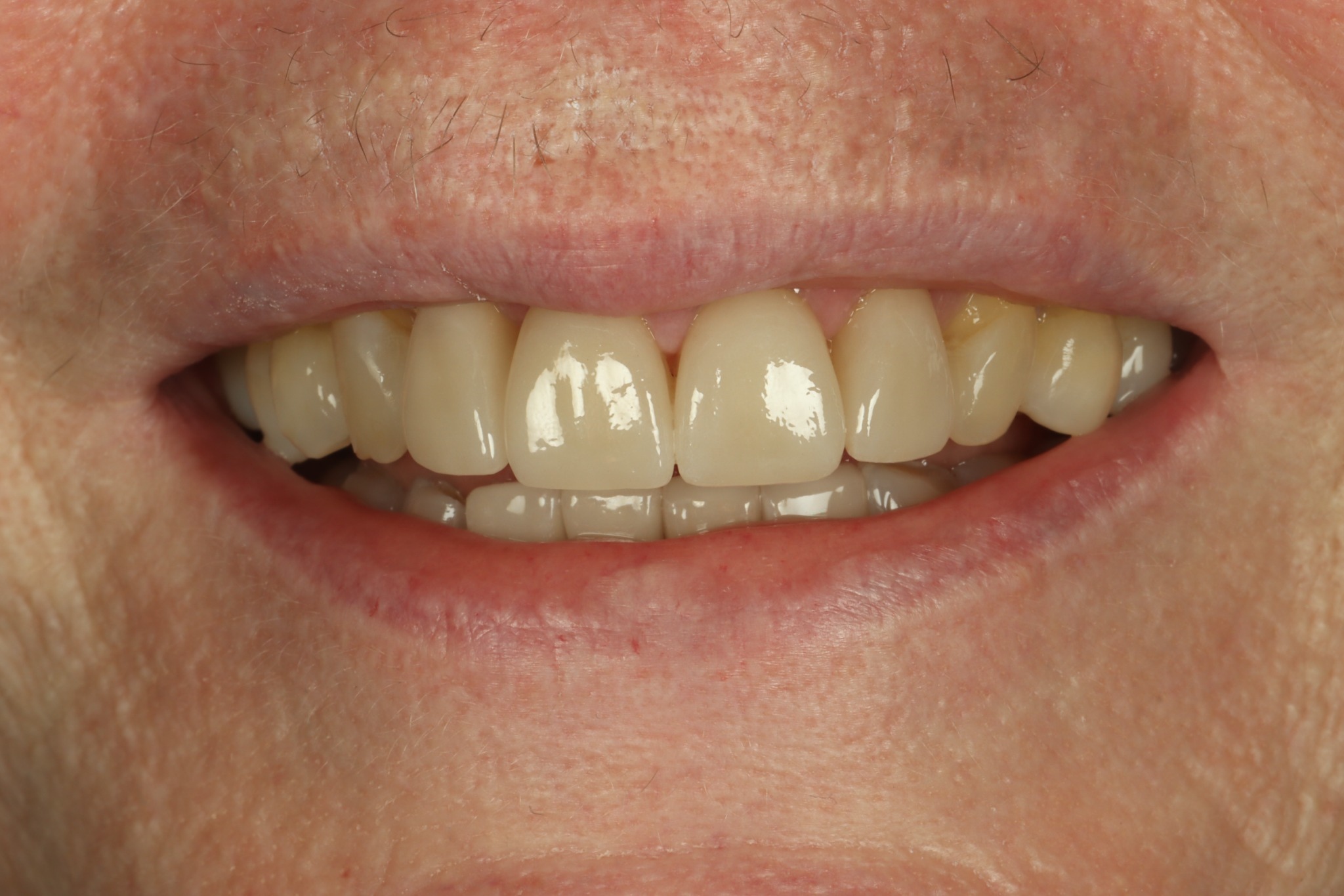 Christine K after dental veneers