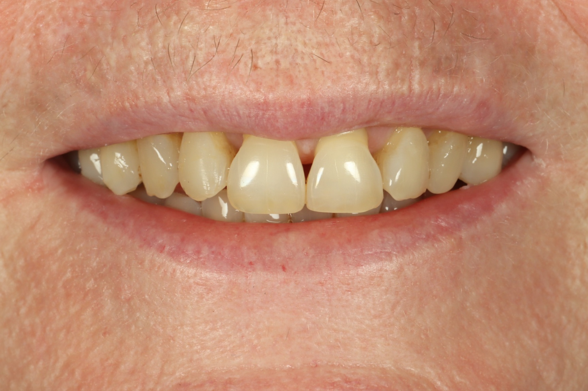 Christine K before dental veneers