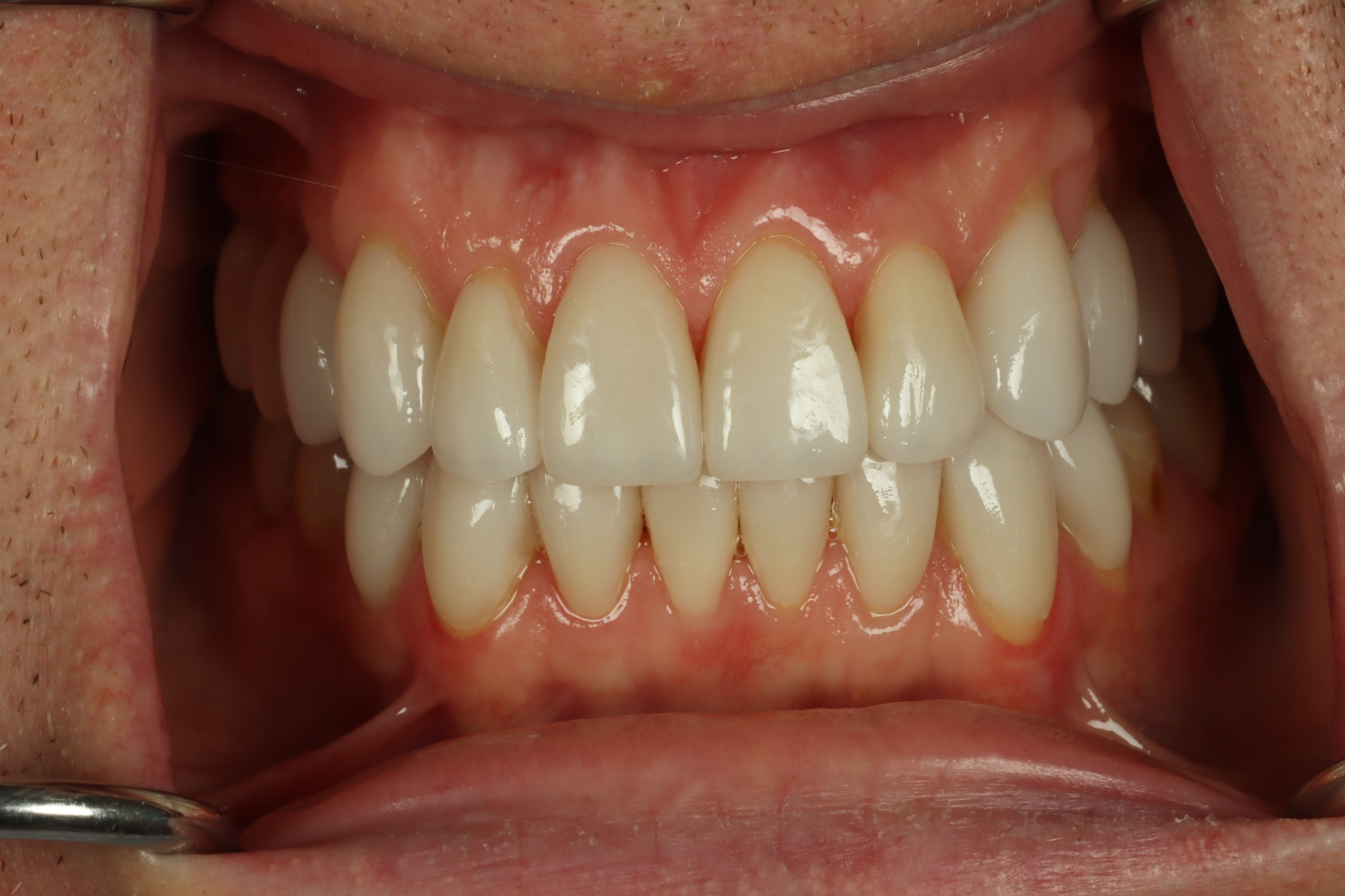 Greg N retracted after worn teeth