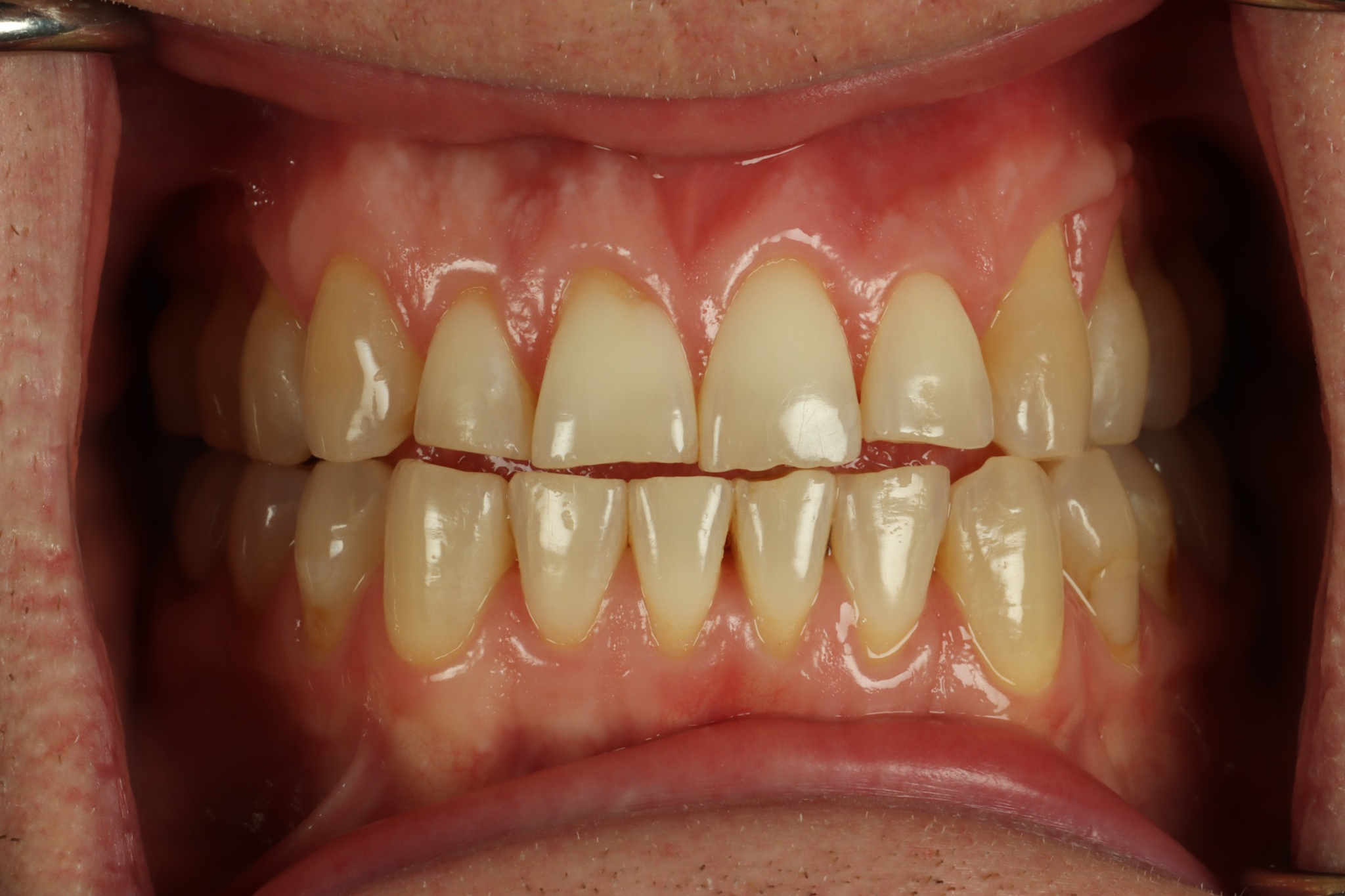 Greg N retracted before worn teeth