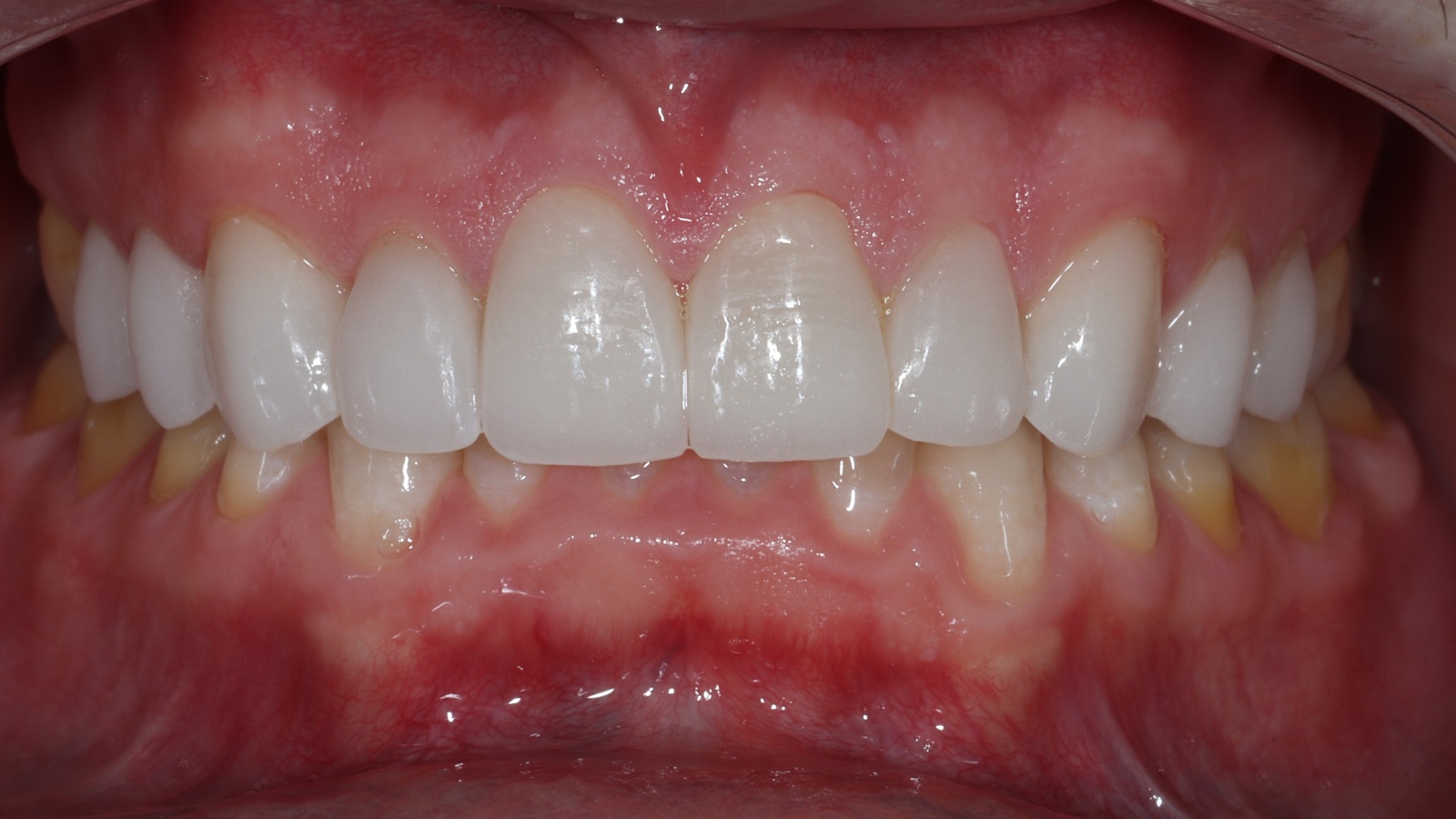 Kyle C after dental veneers