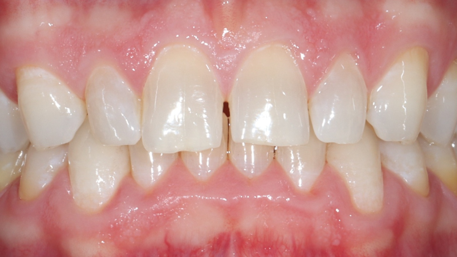 Kyle C before dental veneers
