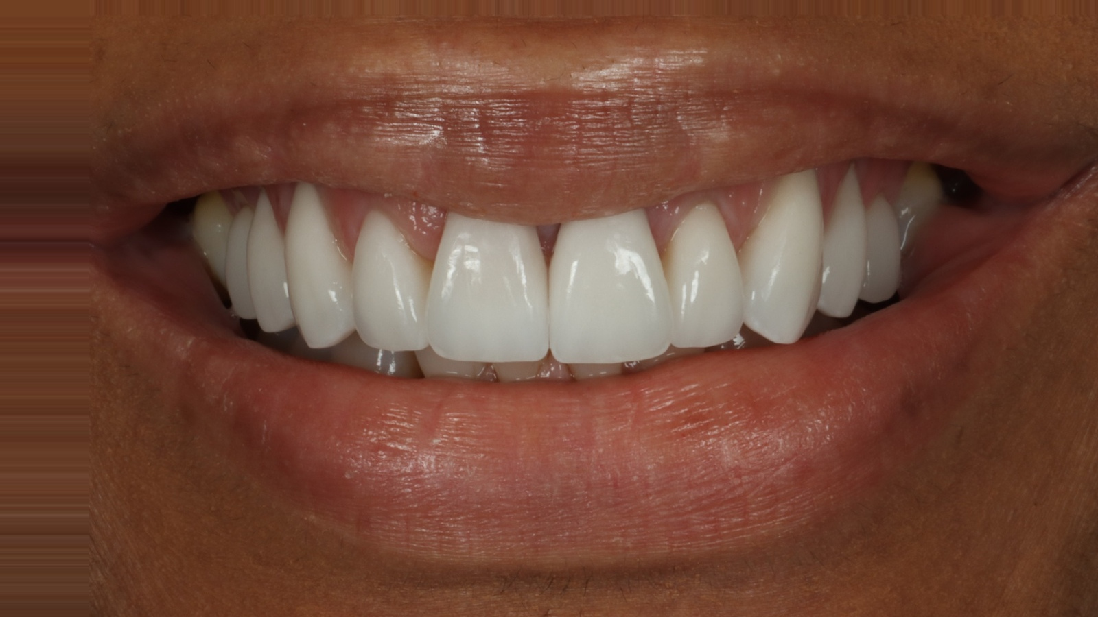 Lalita B after dental veneers