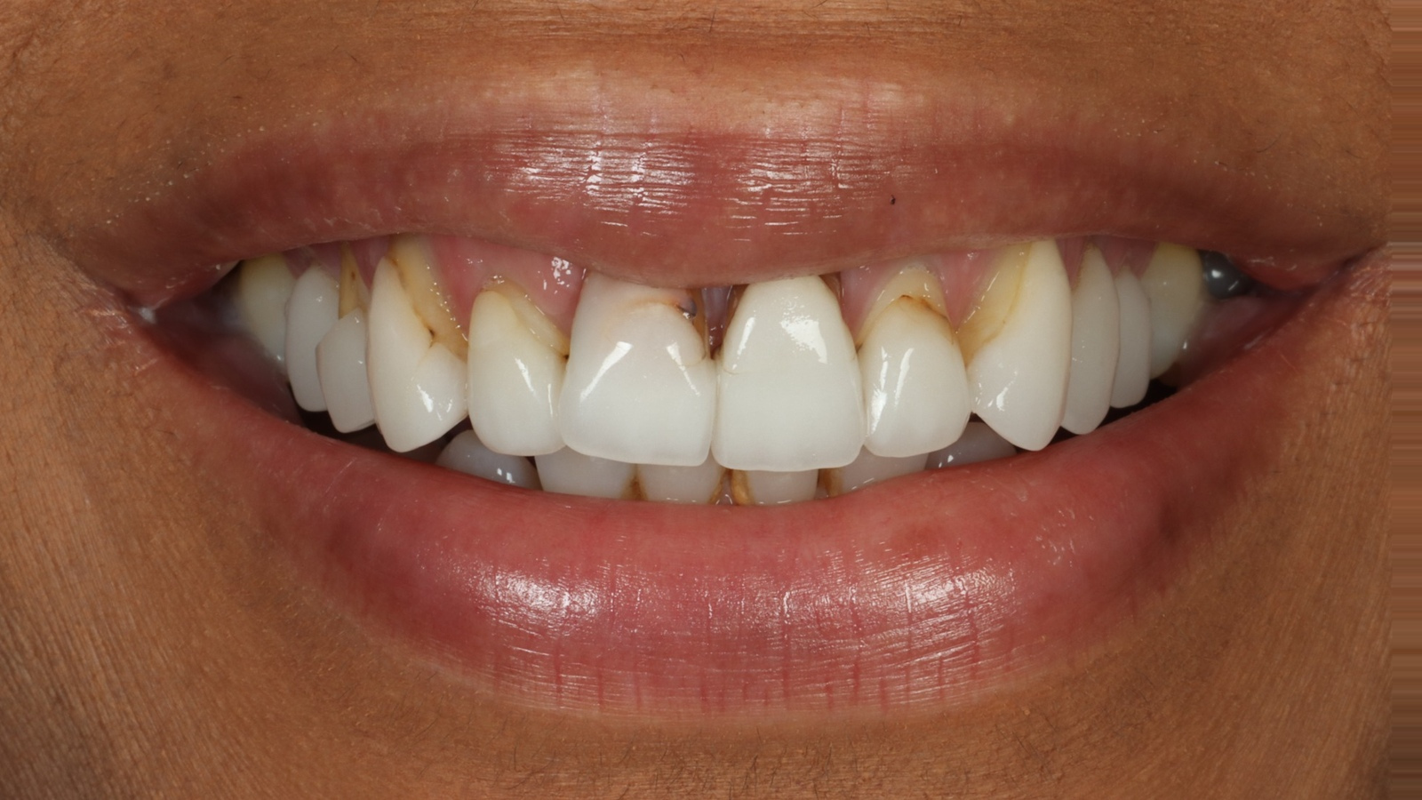 Lalita B before dental veneers