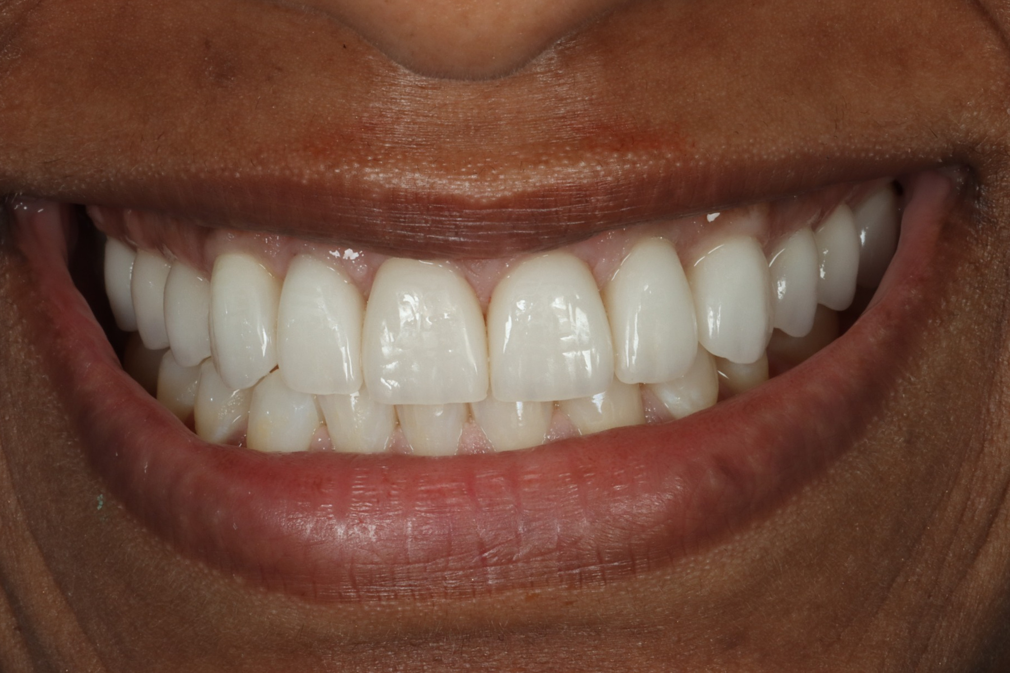 Tina S after dental veneers