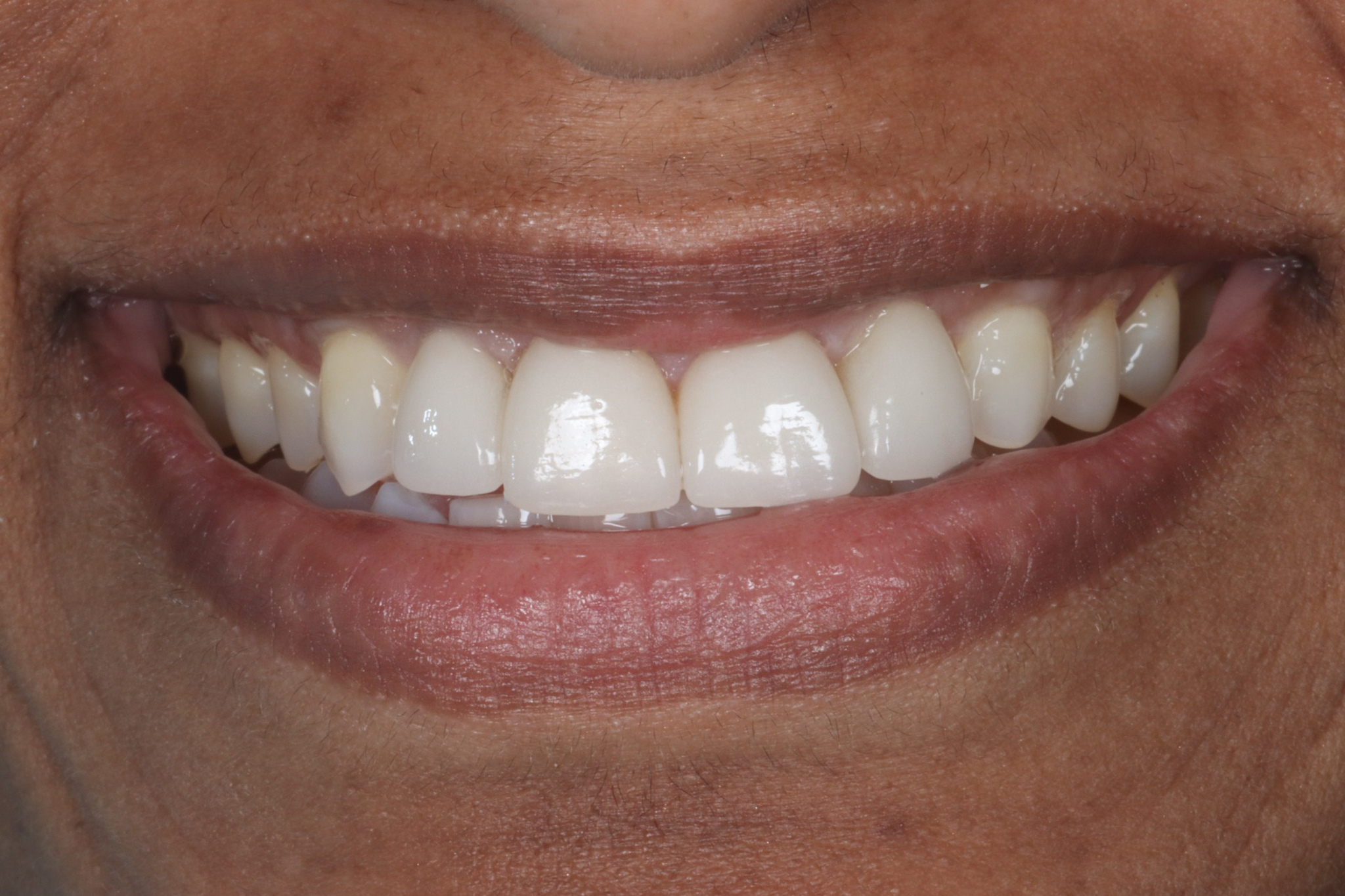 Tina S before dental veneers